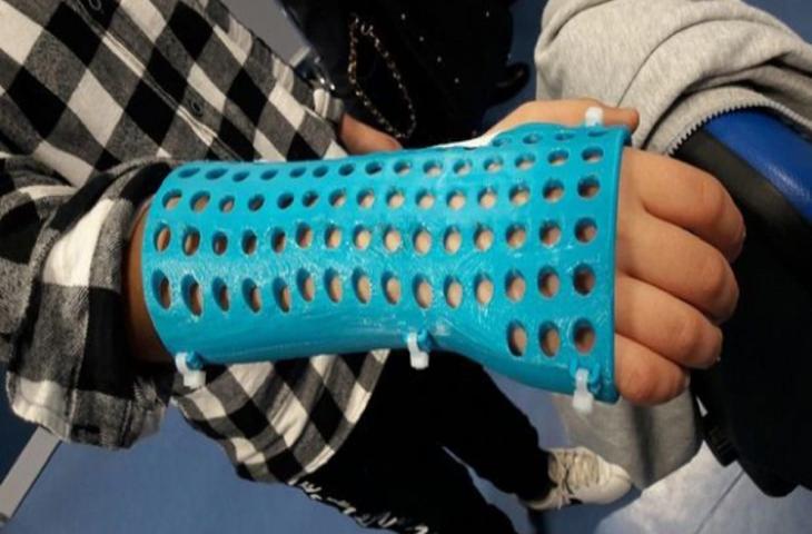 Medicina e innovazione: plastica al posto del gesso 