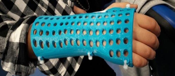 Medicina e innovazione: plastica al posto del gesso 